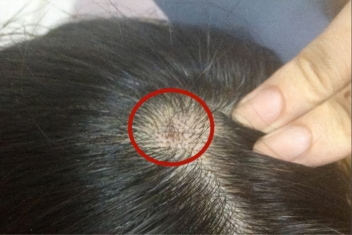 头皮有疙瘩脓包痒痒用什么药,头皮上长红疙瘩和黄色脓包