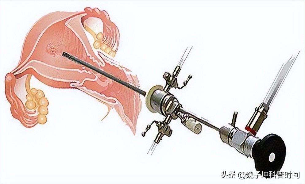 宫腔镜都能查出来什么,宫腔镜检查可以查到哪些病