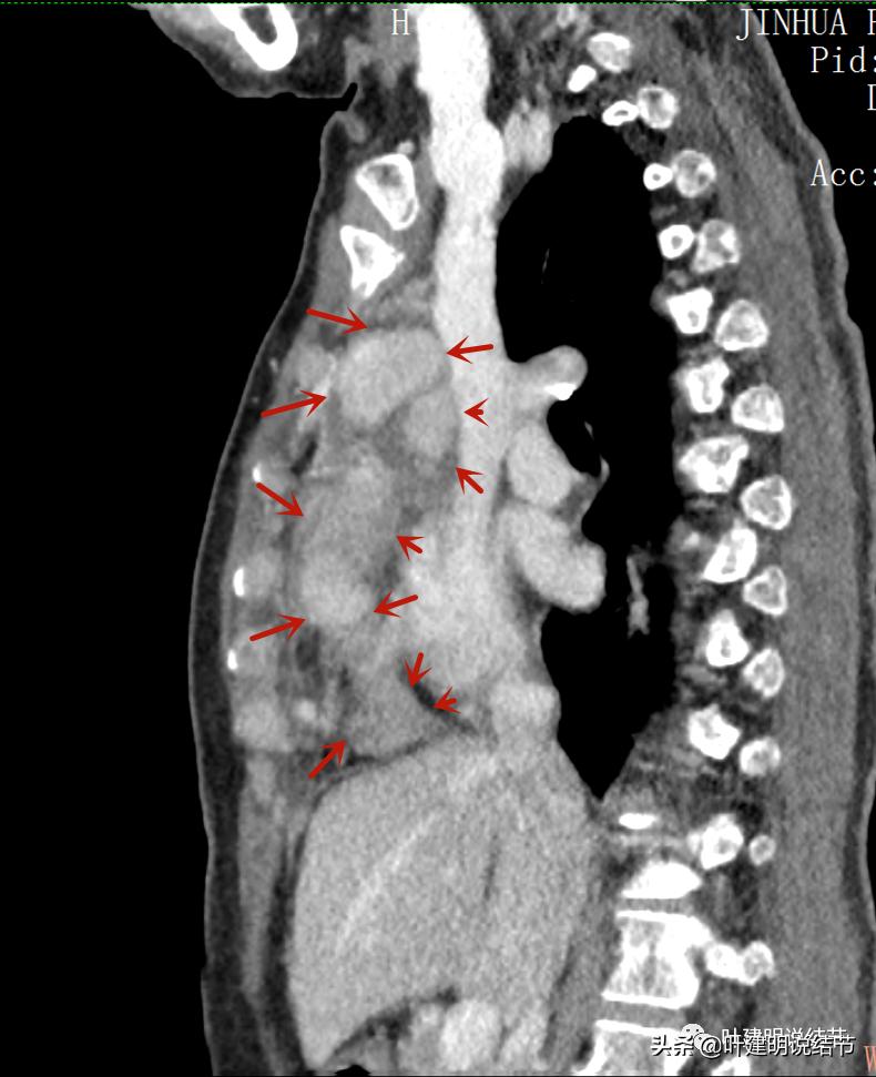 这位老乡，乏力来查，查出这么大个的纵隔肿瘤！会是什么呢？