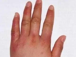 国医大师分2期治冻疮