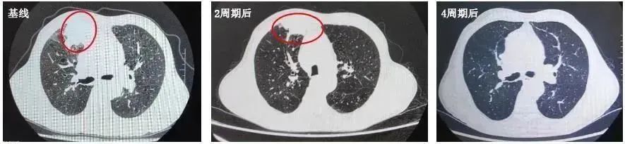 斯鲁利单抗治疗小细胞肺癌生存期,小细胞肺癌3a期用斯鲁利单抗