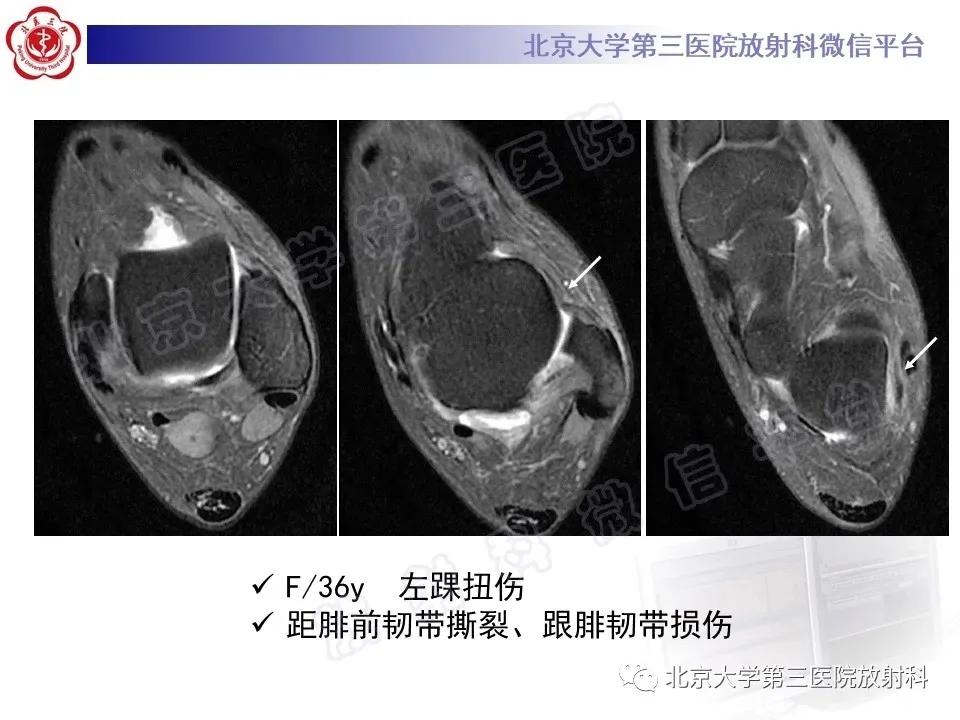 好文分享续集,腓骨肌腱脱位手术价格