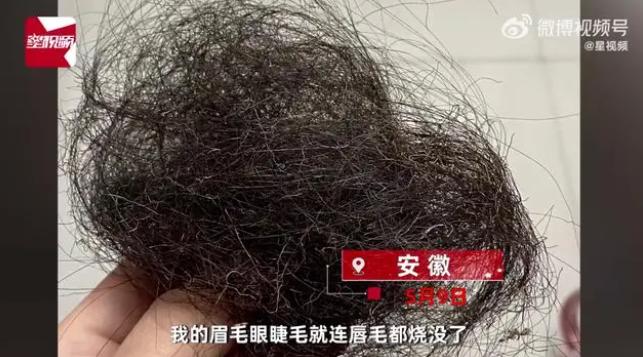 「网红玩具」爆炸！2岁孩子烧伤妈妈，快看看你家有吗？