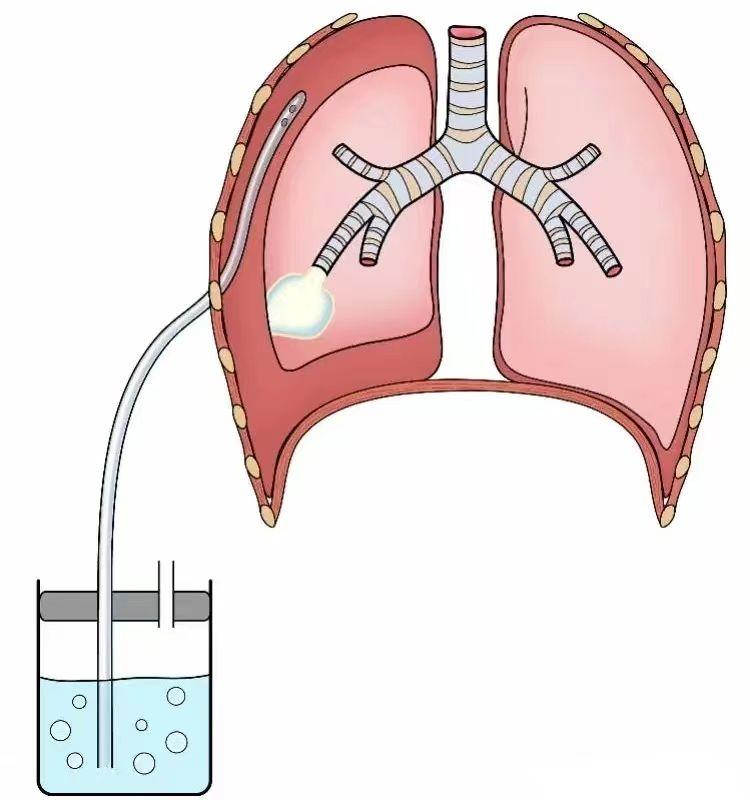 自发性气胸什么卧位,自发性气胸的病史