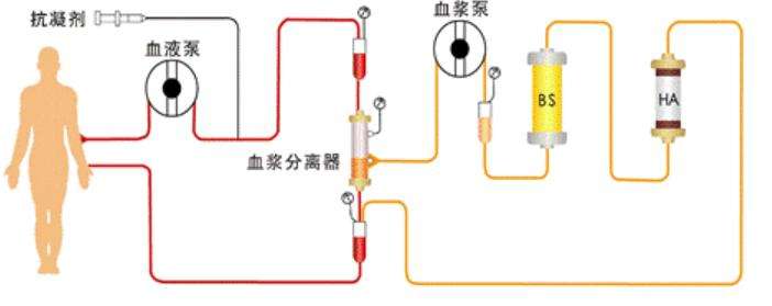 健帆生物人工肝,健帆生物是血液灌流还是血液透析