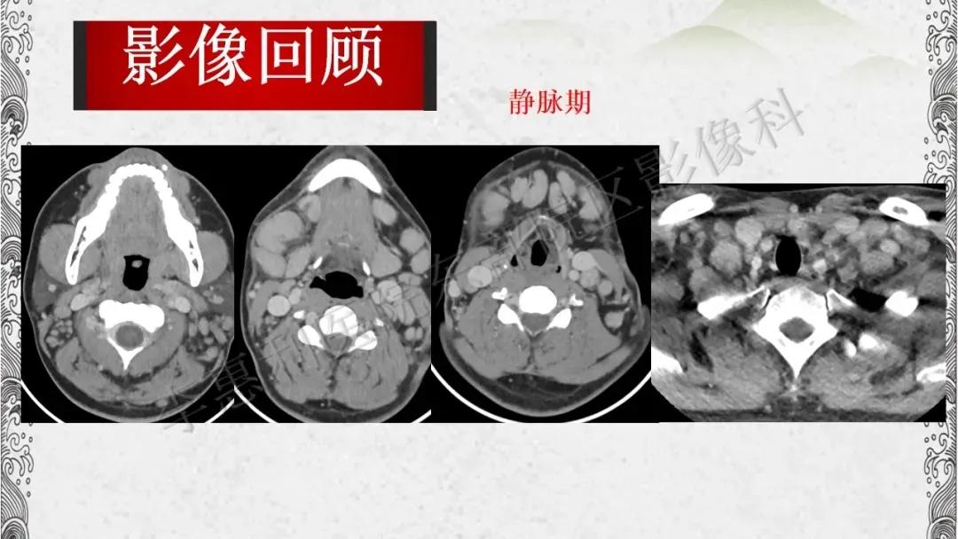 木村病治愈成功案例,木村病诊断案例