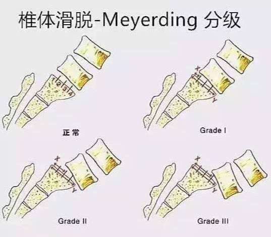 腰椎滑脱手术治疗风险大吗,腰5骶1腰椎滑脱怎么治疗