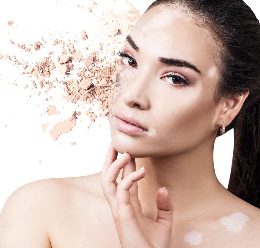 稳定期的白斑怎样快速复色,白斑复色成功