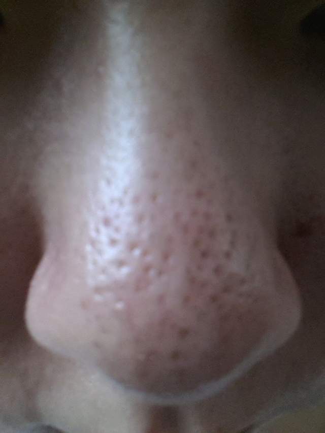 清洁面膜可以去黑头粉刺闭口吗,清洁面膜可以去除黑头吗