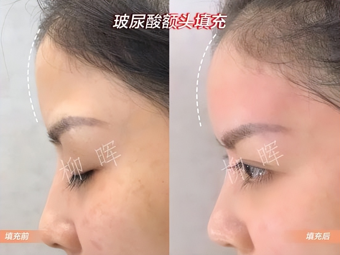 打玻尿酸变美的案例,额头玻尿酸1-7天恢复过程图