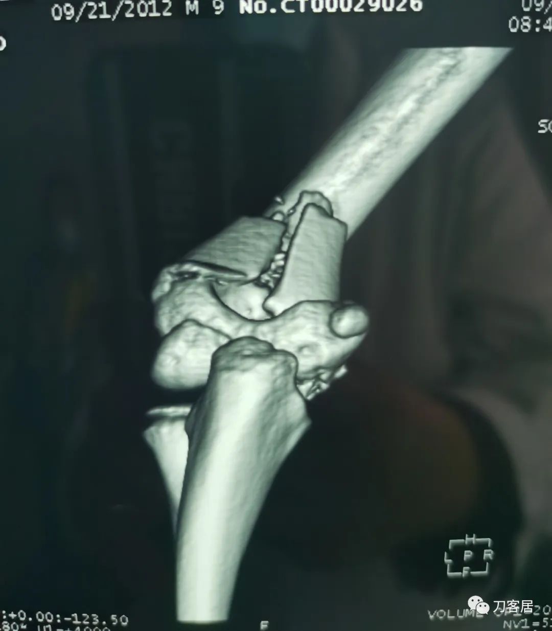 孩子胳膊摔伤肿了不能弯曲一直疼,9岁男孩摔倒手臂痛怎么办