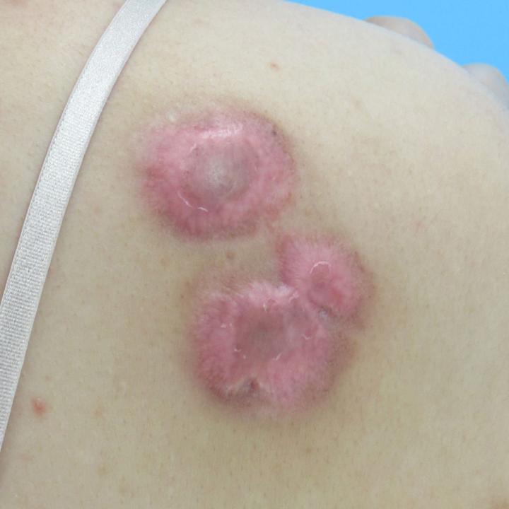 疤痕疙瘩最好的治疗方法,疤痕增生和疤痕疙瘩的区别