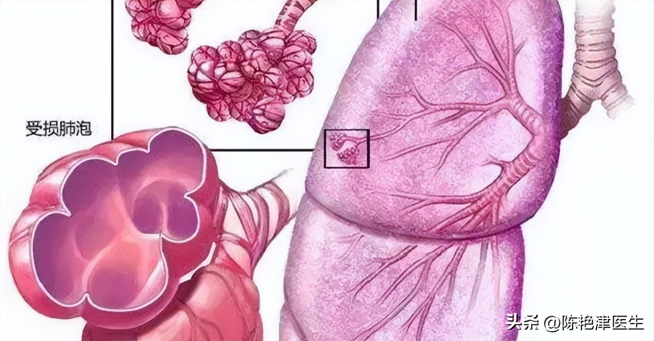 为什么医生不肯说肺大泡有多大,体检肺大疱是什么意思