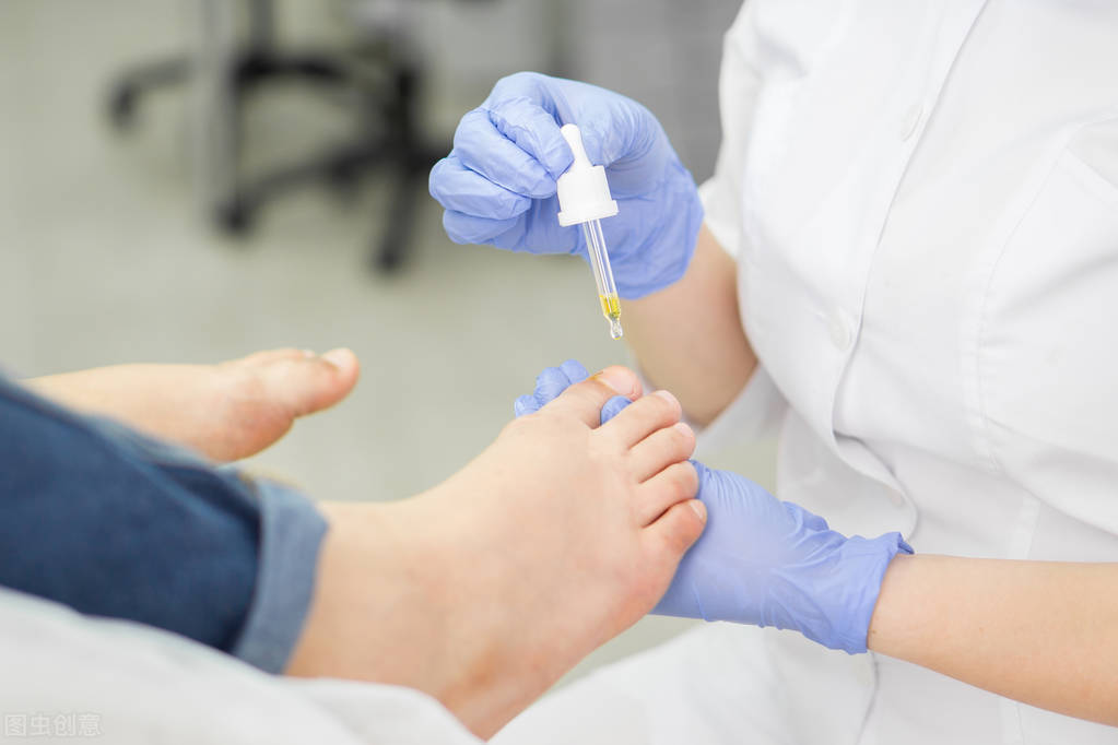 脚趾头脱皮水泡型足癣用什么药膏,足癣脚趾痒红肿怎么办