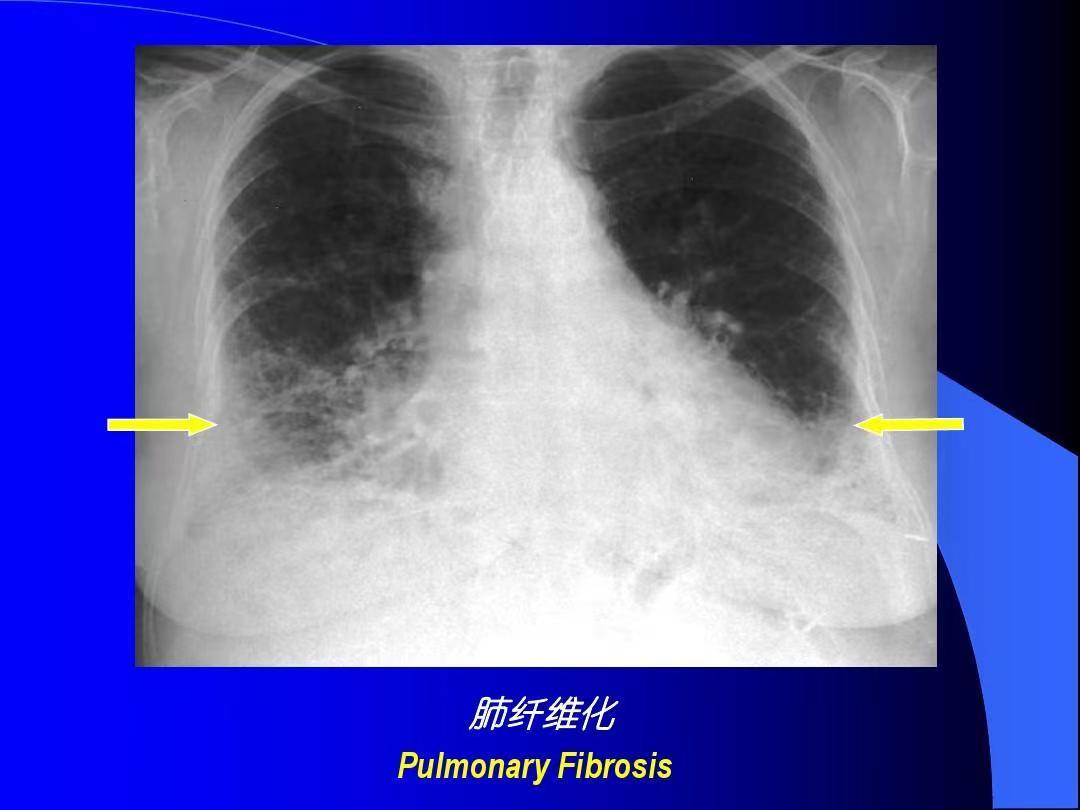 类风湿肺病变怎么治疗,类风湿加肺纤维化会引起上火吗
