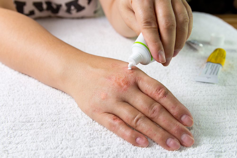 莫匹罗星软膏脓疱病毛囊炎,急性湿疹和脓疱疹的区别