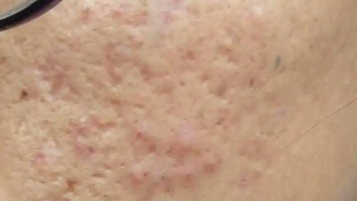 医学那么发达为什么治不了痘坑,想治痘坑但没钱怎么办