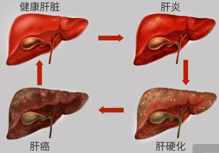 癌前病变和早期癌症有区别吗,癌前病变和癌症有什么关系