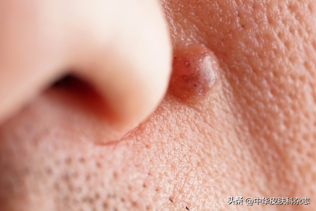 鼻翼红斑有鳞屑,鼻翼有斑是怎么回事