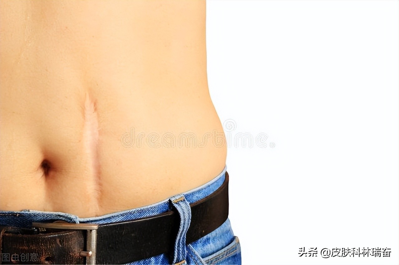 各种疤的修复方法,各种疤痕淡化