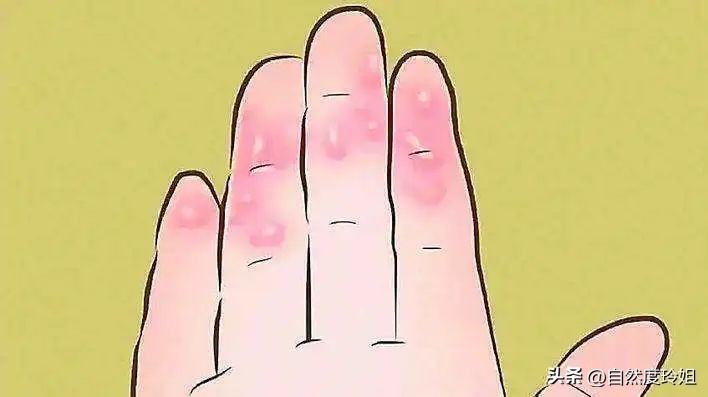 到夏天手脚就长小水泡能治愈吗,每到夏天手脚起小水泡不痒怎么办