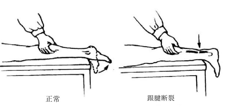 跟腱断裂对运动员的影响,运动员跟腱疼痛怎么解决