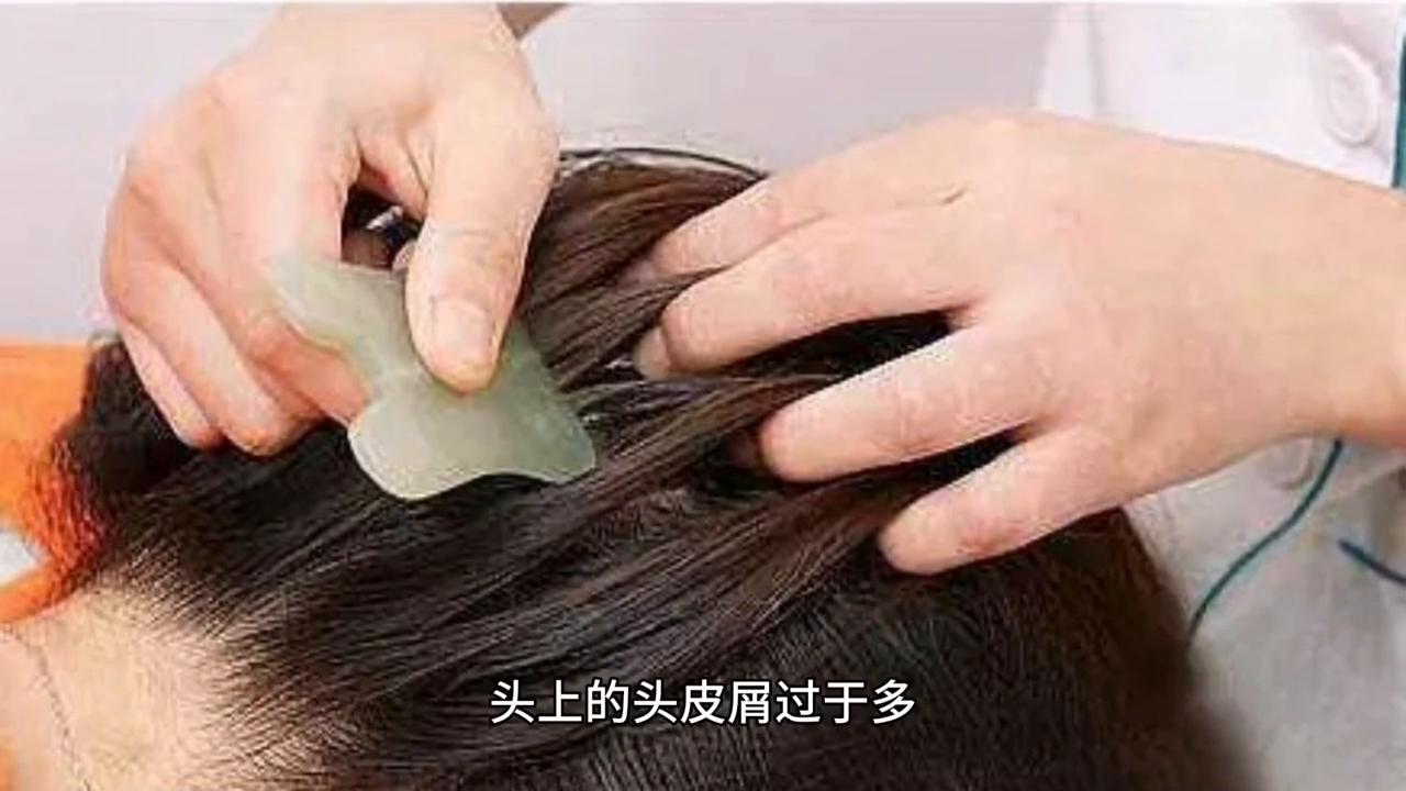 头皮屑有红色结痂,头皮屑有救了