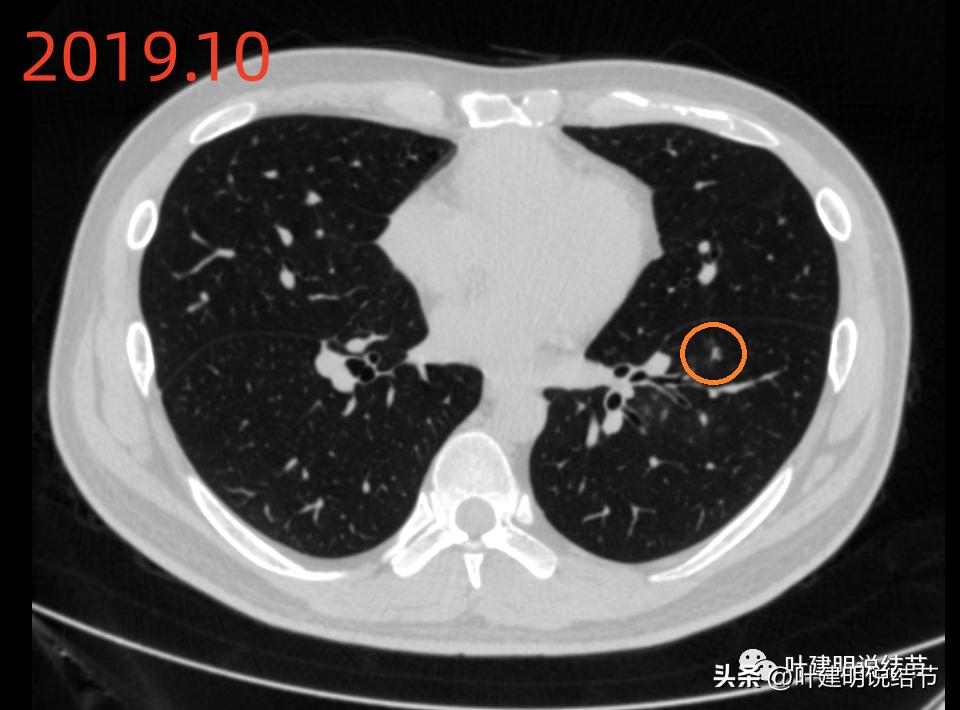 肺炎好了磨玻璃结节还存在,球形肺炎治愈后肺部留有结节