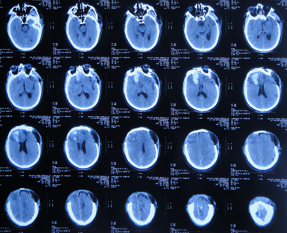 脑外伤后硬膜下积液颅骨修补,颅骨修复手术失败导致脑积水