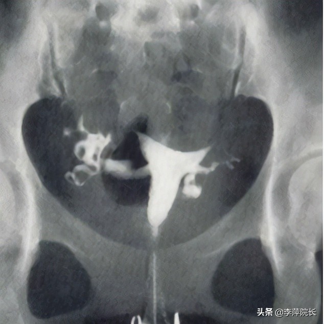 输卵管疏通手术被坑,输卵管通而不畅医生建议手术