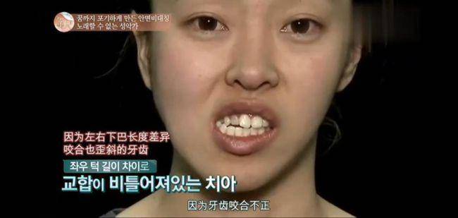 吃饭咬到腮帮子缺维生素吗,吃饭总咬腮帮子吃什么药