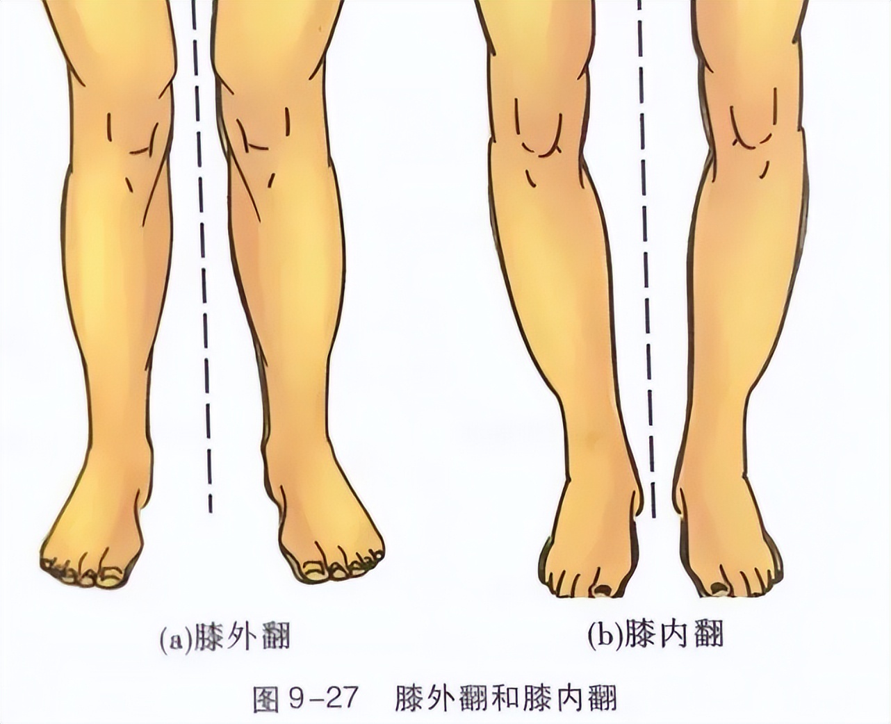 膝关节疼痛是怎么回事怎样治疗,膝关节发软无力疼痛如何缓解