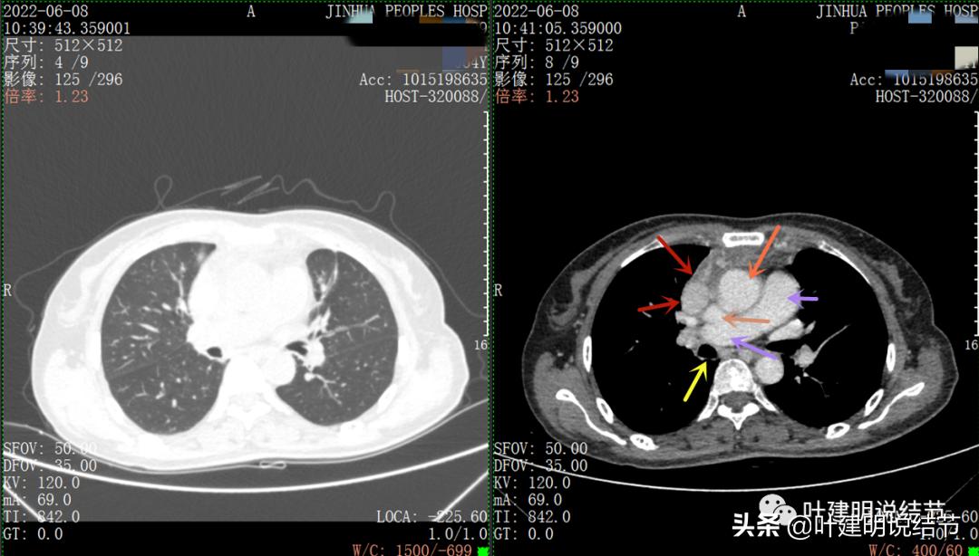 这位老乡，乏力来查，查出这么大个的纵隔肿瘤！会是什么呢？