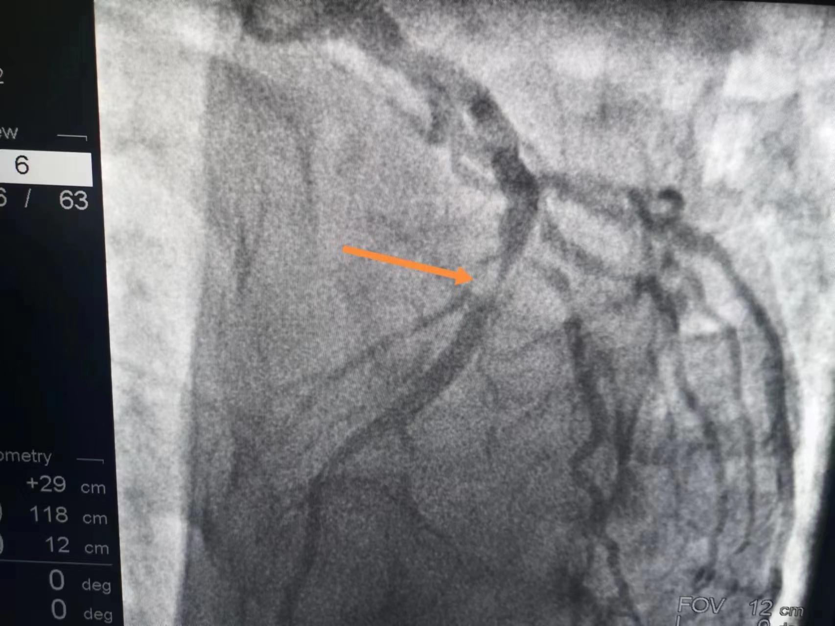 80岁老人得心梗无法手术无法溶栓,42岁突发心梗已下支架