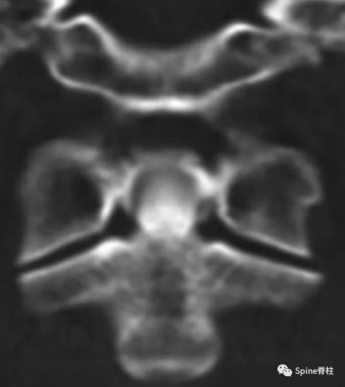 颈椎常见病变图片,颈椎严重的病例
