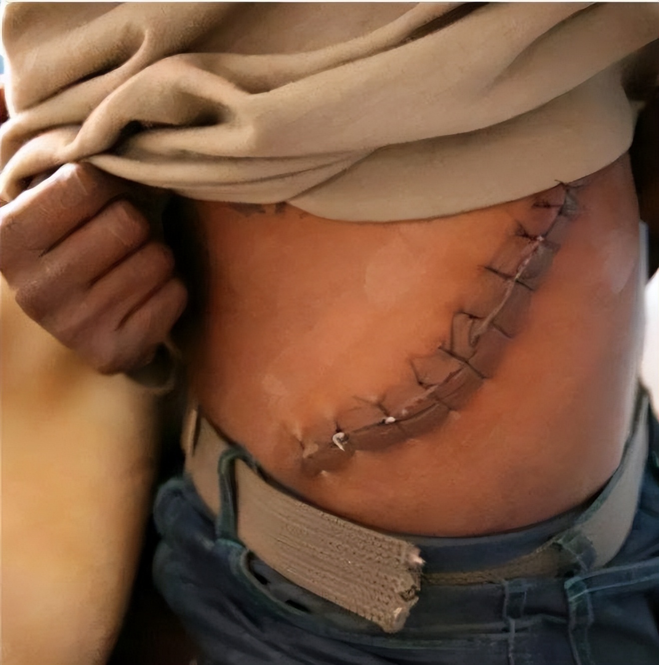 尼泊尔单肾村的故事,尼泊尔单肾村