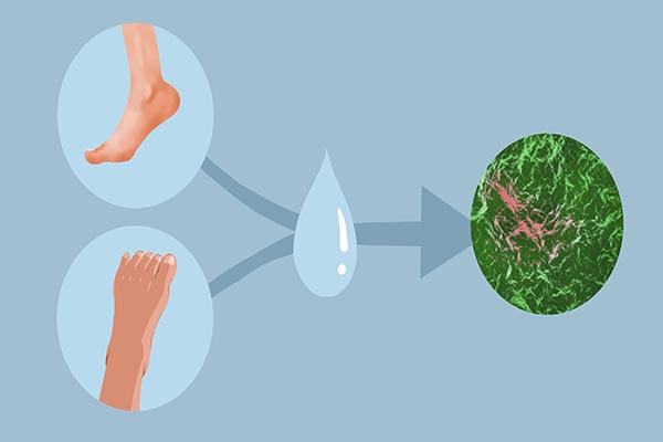 脚气湿疹如何治疗效果最好,脚气湿疹根治方法有哪些