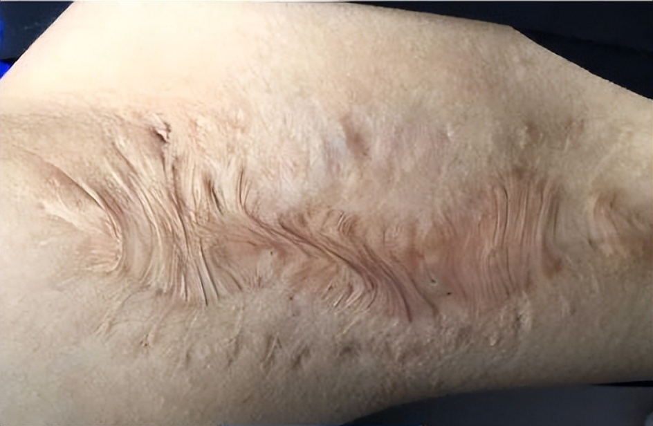 烧烫伤疤痕能彻底修复吗,烧烫伤疤痕修复