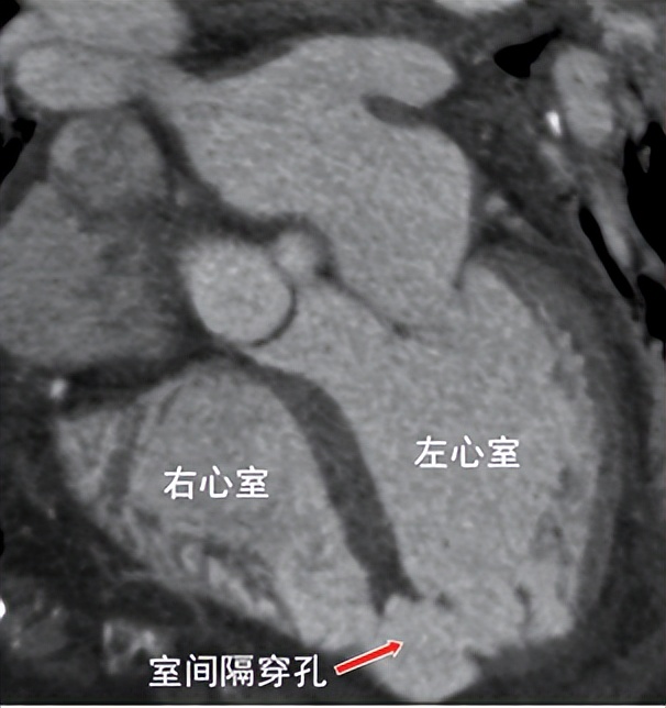 92岁老人心梗后室间隔穿孔四川大学华西医院心脏内科团队通过微创介入技术成功救治