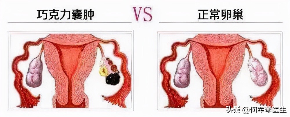 不要被肿瘤吓到,卵巢囊肿是怎么回事