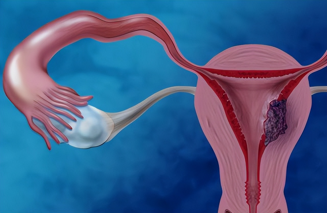 为什么月经结束后，会出现“褐色分泌物”？如果你也有，要重视