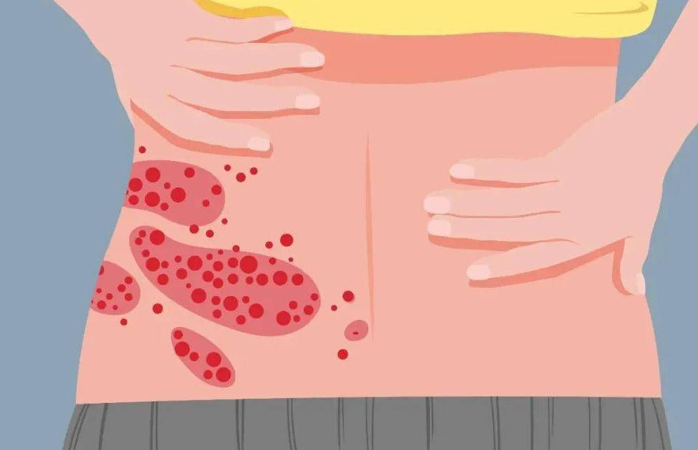 得了带状疱疹痒的睡不着,带状疱疹疼痛难忍三步简单解决