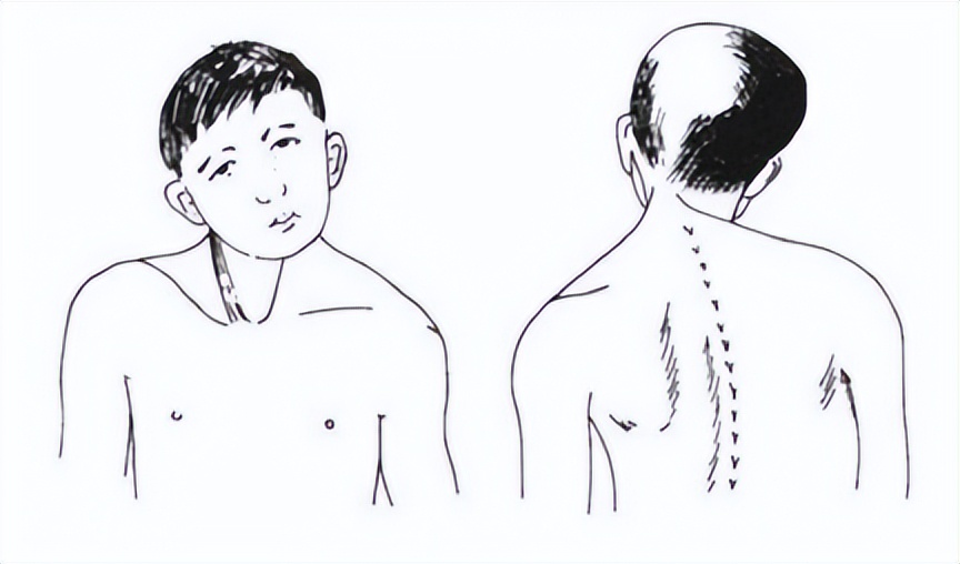 脖子歪睡觉能扶正吗,歪头多久可以矫正