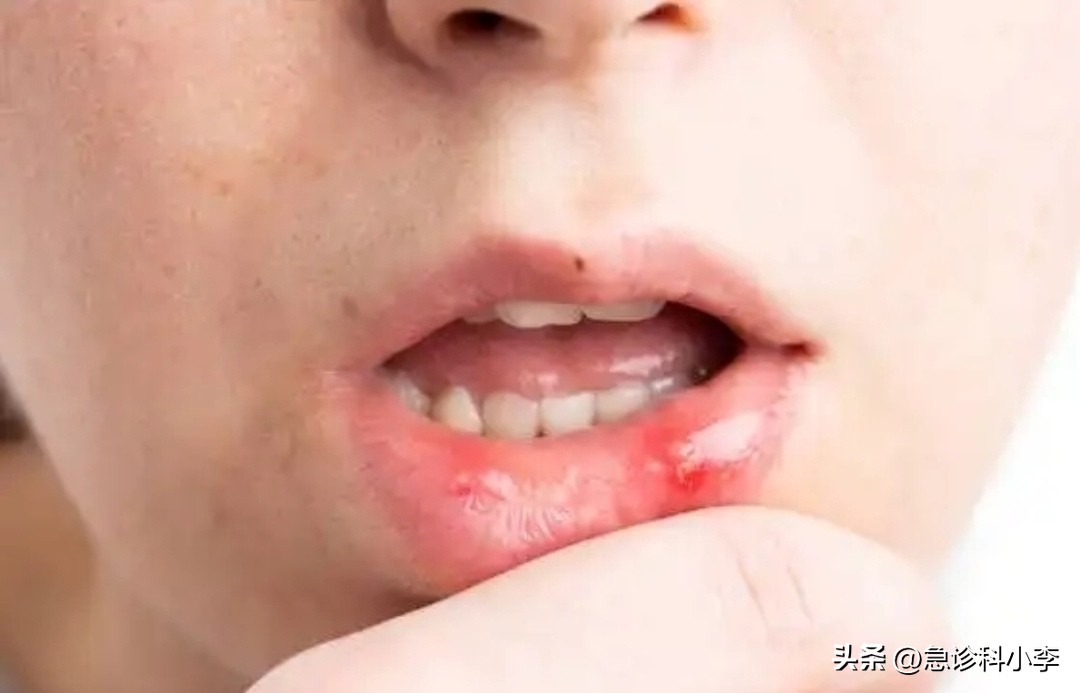 口腔溃疡根本不是维c的事,口腔溃疡维c的作用与功效