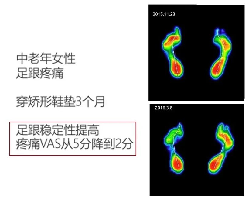 足弓消失的扁平足,改善足弓塌陷跪姿双脚要不要并拢
