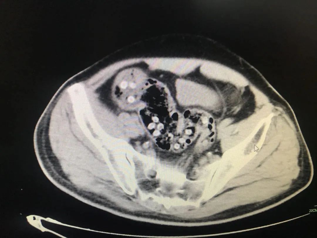 小孩子发烧便血,5岁女孩腹泻高烧怎么处理