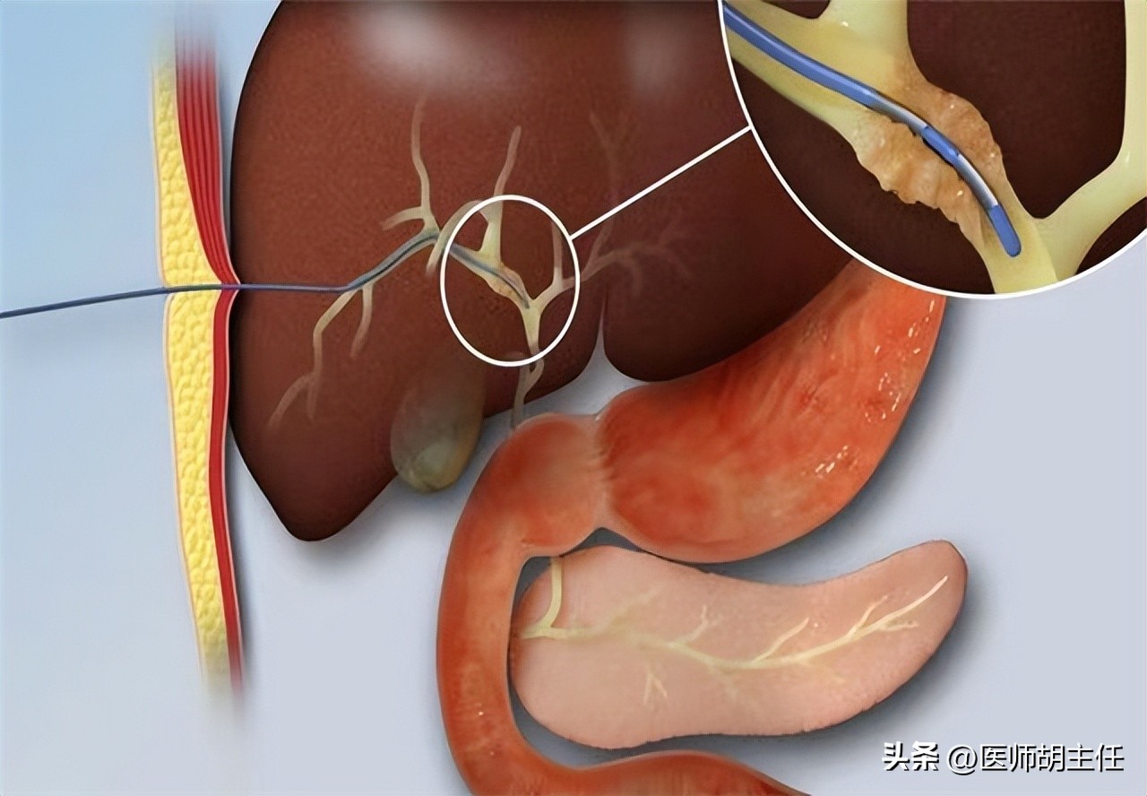 体检发现胆红素高是怎么回事,体检胆红素高怎么快速降下来