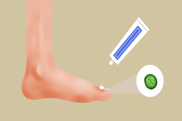 脚气湿疹如何治疗效果最好,脚气湿疹根治方法有哪些