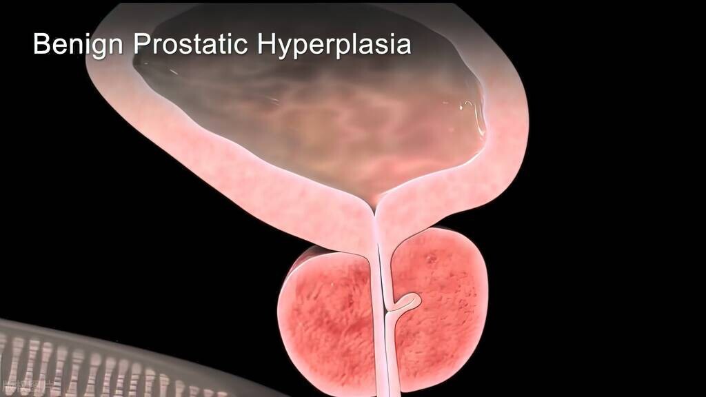 夫妻感情破裂造成惨剧,女性海绵体破裂是什么原因造成的