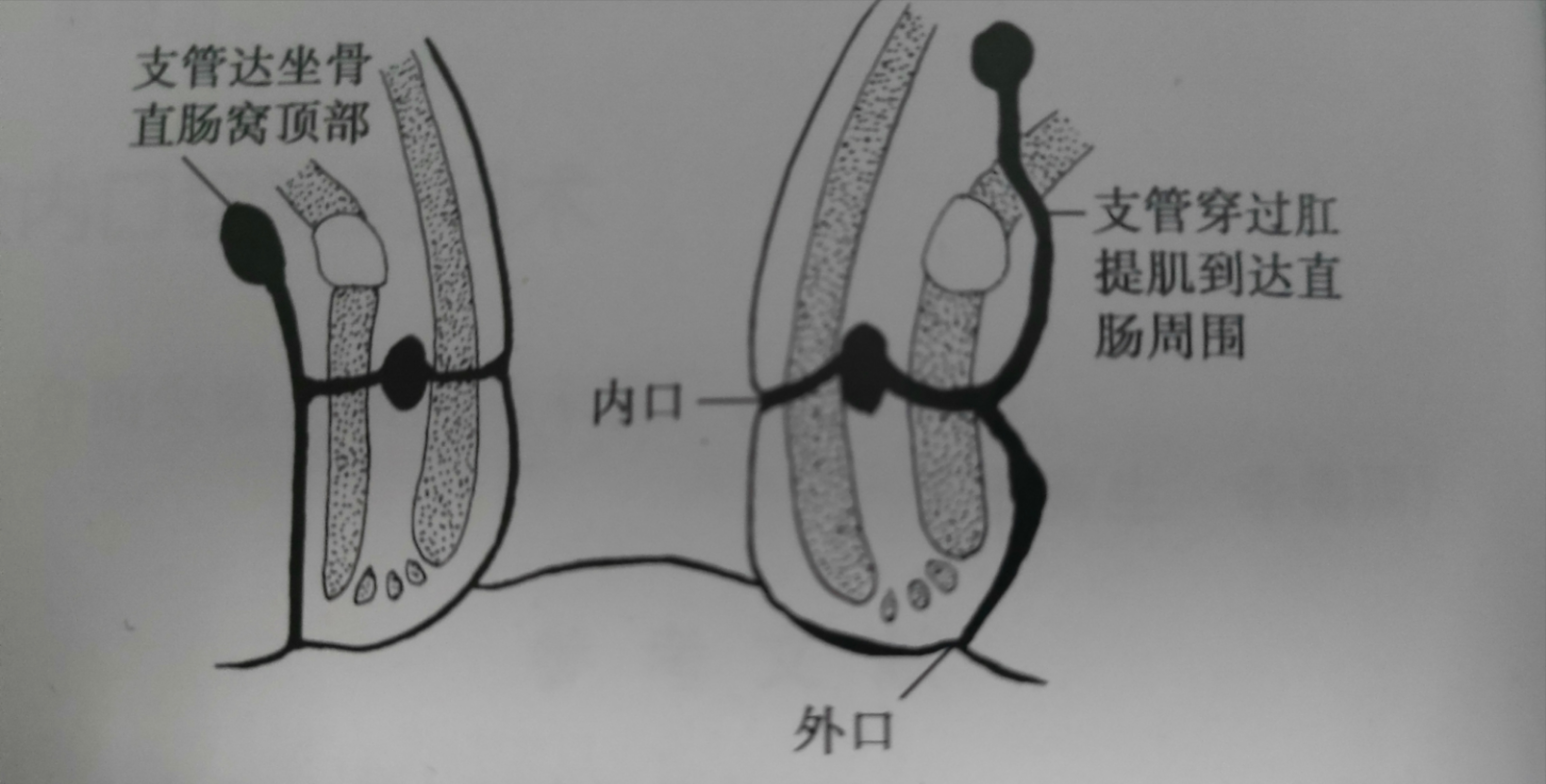 为什么有些人肛瘘一个星期就好了,为什么有的肛瘘术后不需要换药